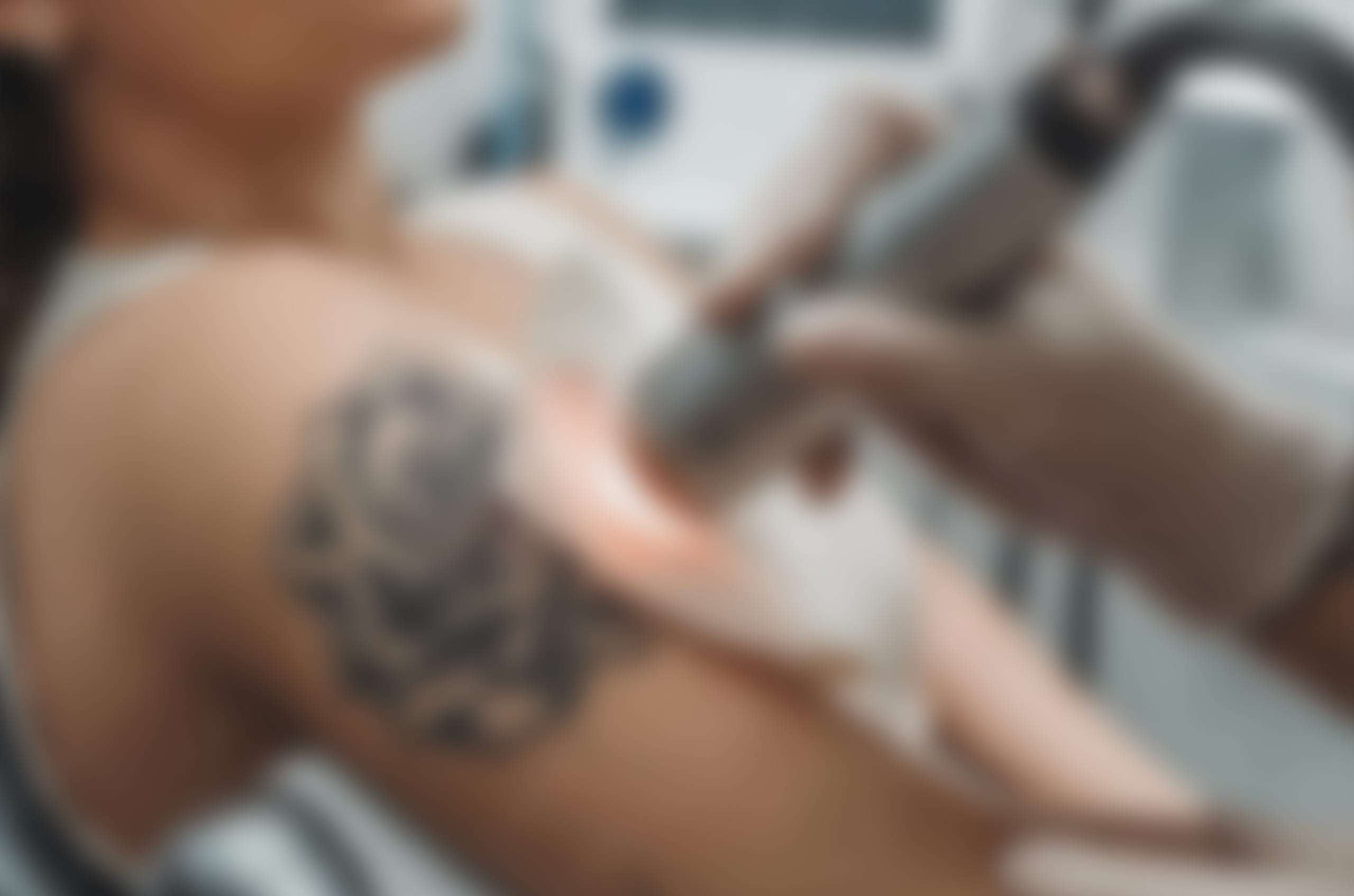 Eliminación de tattoos con láser